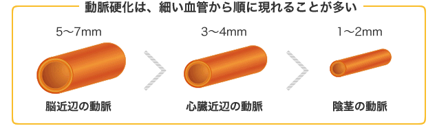 動脈硬化は、細い血管から順に現れることが多い